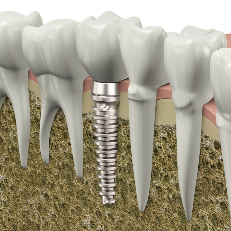 Benefits Offered by Porcelain Crowns in Rockville, MD