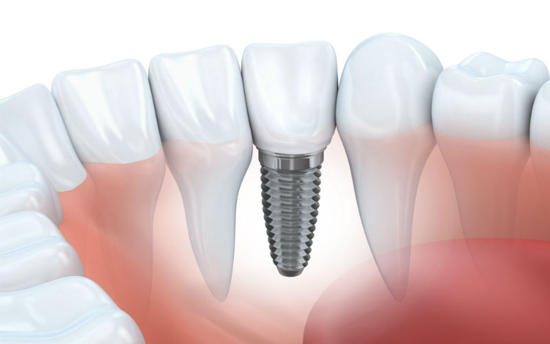 Learn More About Dental Implants in Baltimore, MD