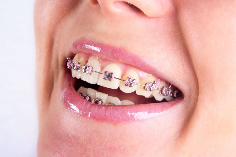 What Is Available Through Orthodontic In Cedar City, UT?