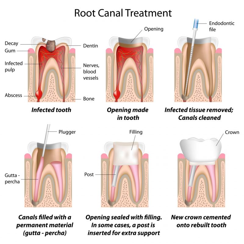 Advantages of Root Canals in Del City OK