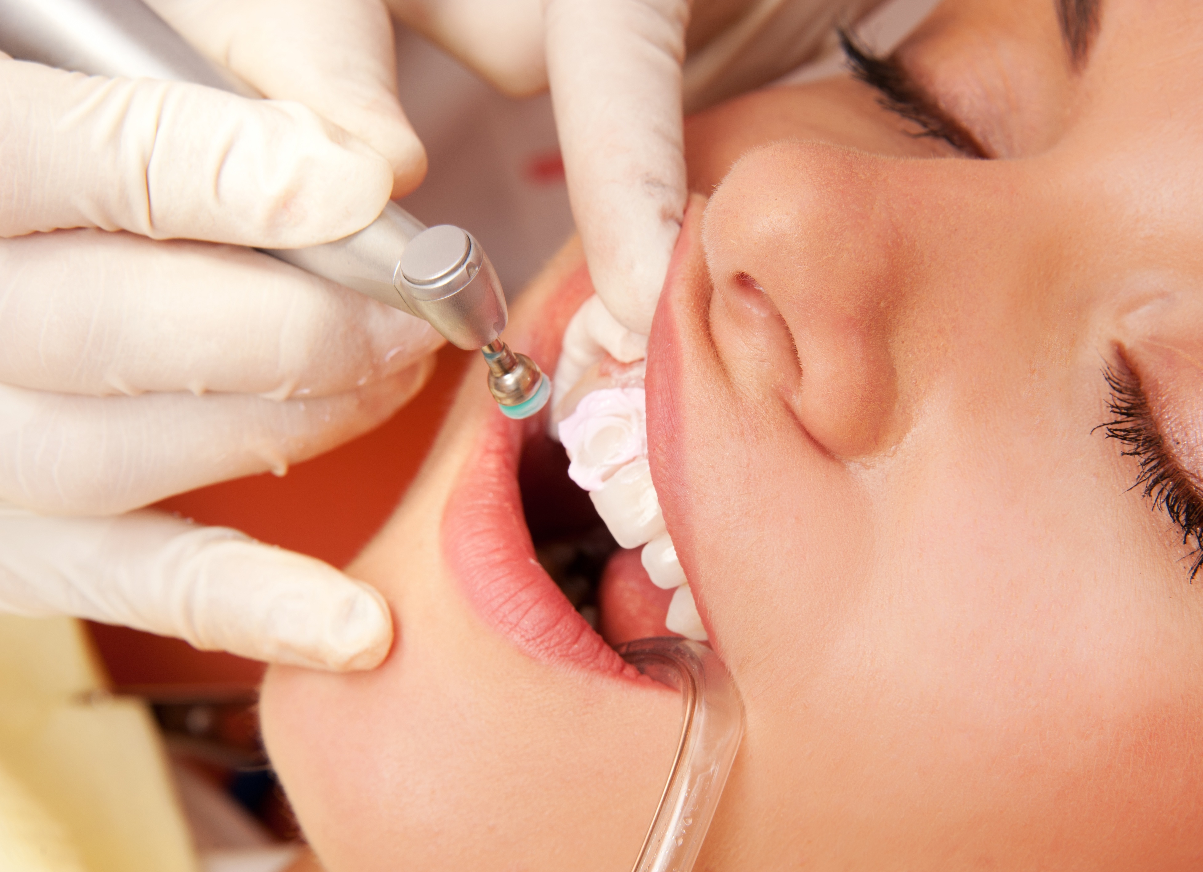 Castle Hill Dentist: Why Visit Bi-Annually