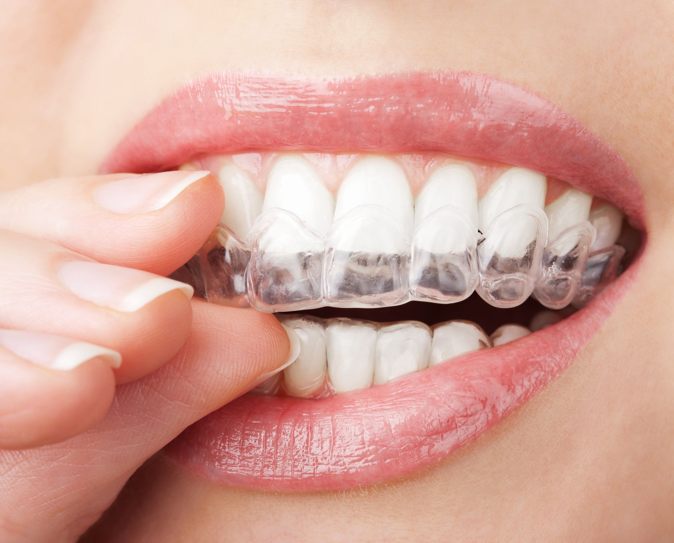 Achieve a Confident Smile with Invisible Braces in Long Beach, CA